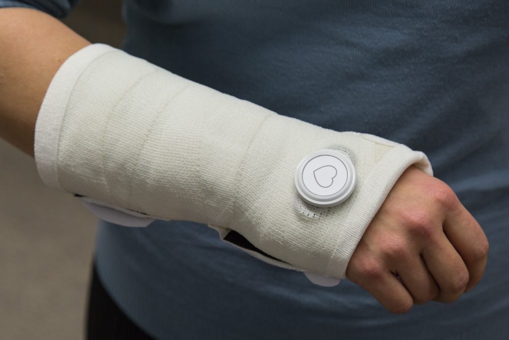 Wrist cast with a motion sensor attached to the cast.